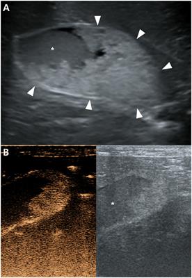 Case Report: Imaging Features of Gallbladder Sessile Polyp Confirmed by Contrast-Enhanced Ultrasonography and Dynamic Computed Tomography in a Dog With Asymptomatic Chronic Cholecystitis
